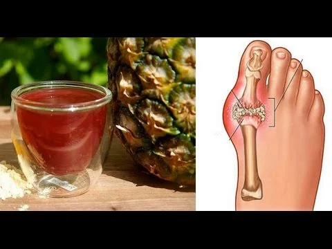  Prevent Gout And Joint Pain