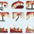 Trường hợp mất răng nào nên làm cầu răng