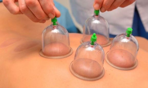 Cupping therapy