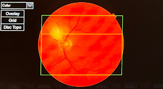 Close up photo of Joel's retina
