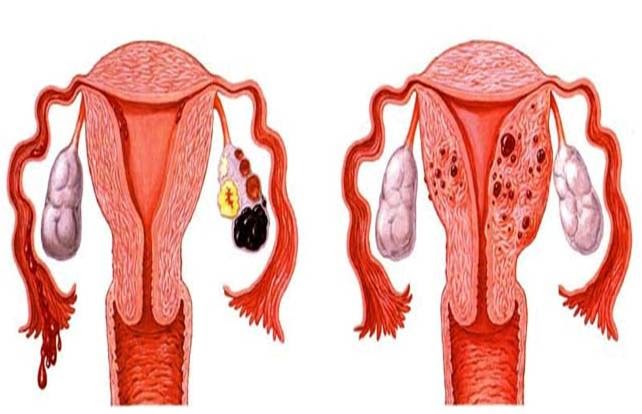 PAD HERBA : ALTERNATIF KESIHATAN WANITA: Kenali Penyakit 