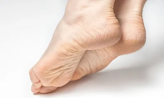 care for dry feet