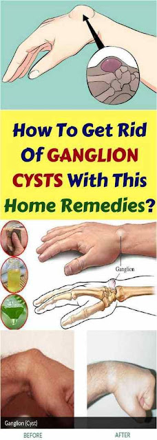 How to get rid of ganglion cysts with this home remedies?