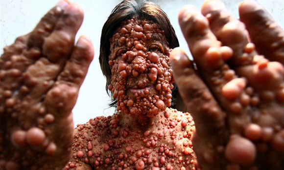 Chandra Wisnu, The 'Bubble Skin Man' Of Indonesia