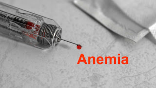 Anemia