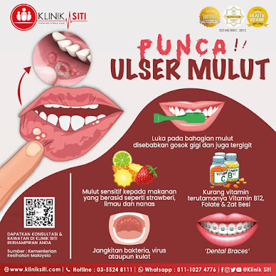 Inforgrafik ulser mulut