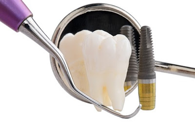 Tác dụng cấy ghép răng với implant