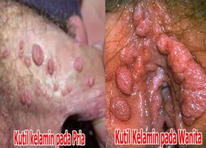 obat kutil kelamin herbal