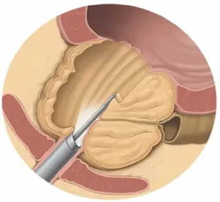 Guía para tratar la próstata inflamada de forma natural