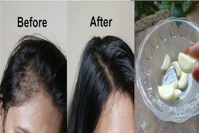 Grandma's SECRET Recipe for Hair growth in 30 days Garlic & Coconut hair oil treatment