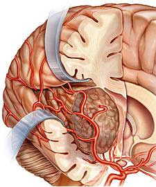 Tumor Otak