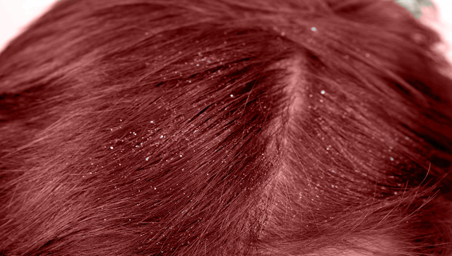 Dandruff Hair Loss  and  Causes of Dandruf