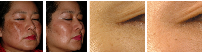 para que serve niacinamida antes e depois - niacinamida para melasma e anti-idade