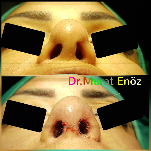 Tertiary Revision Nose Tip Plasty, 3rd Revision Nose Tip Correction Surgery in Istanbul