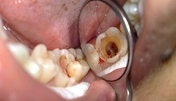 Cách phòng ngừa sâu răng cho trẻ ba mẹ cần biết