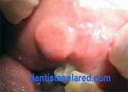 <Img src ="fibroma-mucosa-carrillo.jpg" width = "180" height "130" border = "0" alt = "Bulto en el carrillo">