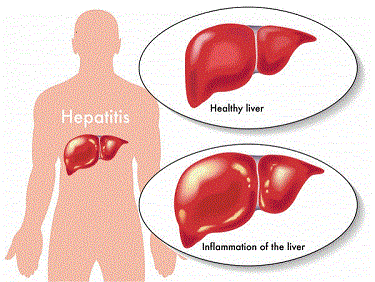 En La Paz se registran hasta 10 casos de hepatitis B al año