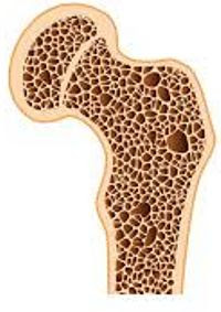 Muestra un fémur humano poroso, a causa de una osteoporosis