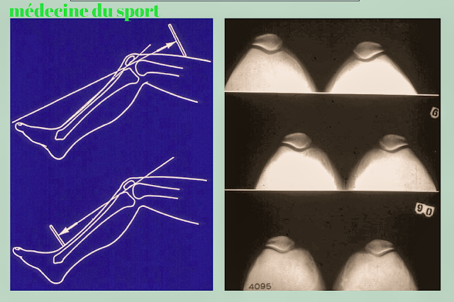 IMAGERIE DU GENOU APPLIQUÉE A LA PATHOLOGIE SPORTIVE (