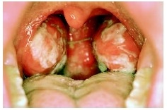 mononucleosis