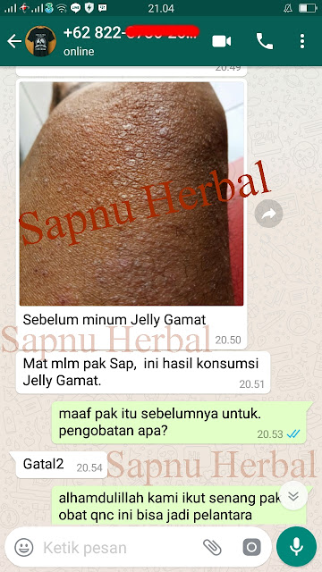 Obat Gatal Menahun Yang Sangat Manjur Mengobati Sampai Tuntas