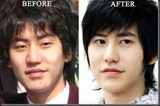 Kyuhyun-Plastic-Surgery