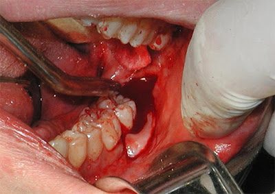 Cách phòng tránh chảy máu kéo dài sau khi nhổ răng