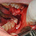 Cách phòng tránh chảy máu kéo dài sau khi nhổ răng