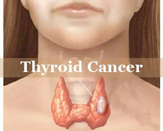 Thyroid Cancer treatment