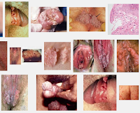 Gejala Kutil Kelamin dan Pengobatan secara Alami