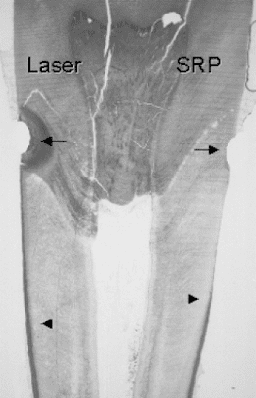 Undecalcified ground section of root surfaces treated by laser irradiation (left) and hand instrumentation (right). Bur marks and apical end of instrumentation are indicated by arrows. Note the complete removal of cementum after hand instrumentation in contrast to preserved cementum layer after laser irradiation. Magnification 2 x .