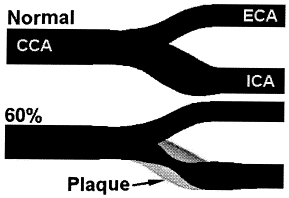 Ardiana's: Artery Carotid Plaque