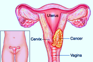 Cervix Cancer Definition