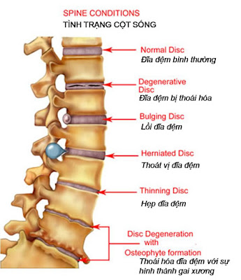  Nhiều nguyên nhân gây bệnh thoát vị đĩa đệm