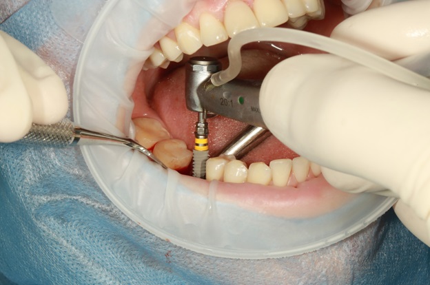 Is It Better To Dental Implants Or Bridge Work?