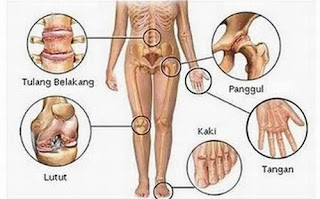 Cara Menurunkan Asam Urat Dengan Bahan Alami, Cara Mengatasi Asam Urat Dan Obatnya, Obat Asam Urat Yg Efektif, Obat Asam Urat Lansia, Penyebab Asam Urat Susah Turun, Cara Pengobatan Asam Urat Secara Medis, Obat Untuk Asam Urat Akut, Cara Penyembuhan Asam Urat Alami, Obat Penyembuh Sakit Asam Urat, Asam Urat Akibat, Gejala Asam Urat Wikipedia, Asam Urat Akut Sembuh Dengan Teh Pepaya Kelapa, Cara Mengatasi Kaki Asam Urat, Obat Asam Urat Alami Dari Buah Buahan, Obat Alami Untuk Asam Urat Atau Rematik, Obat Asam Urat Generik Untuk Ibu Menyusui, Ciri Asam Urat Rendah, Obat Herbal Asam Urat Hpa, Cara Mengobati Asam Urat Dengan Obat Alami, Manfaat Asam Urat Dalam Darah, Obat Herbal Asam Urat Murah, Penyebab Dan Cara Mengatasi Penyakit Asam Urat, Cari Herbal Asam Urat, Jenis Obat Asam Urat Di Apotik, Obat Penyembuh Asam Urat Dan Kolesterol, Asam Urat Hindari Benjol, Asam Urat Dipijat, Asam Urat Gejalanya Seperti Apa, Obat Herbal Penyakit Kolesterol Dan Asam Urat, Cara Penyembuhan Penderita Asam Urat 