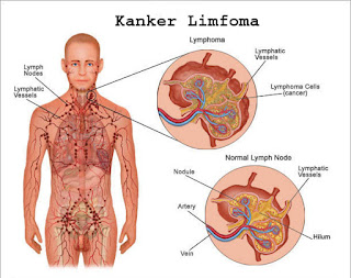 Obat Kanker Herbal Tradisonal Dan Alami 