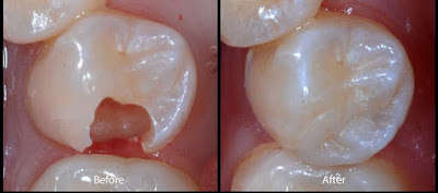 Trám răng có chấm dứt sâu răng hay không?