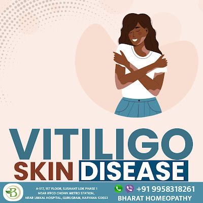 Homeopathic treatment for vitiligo