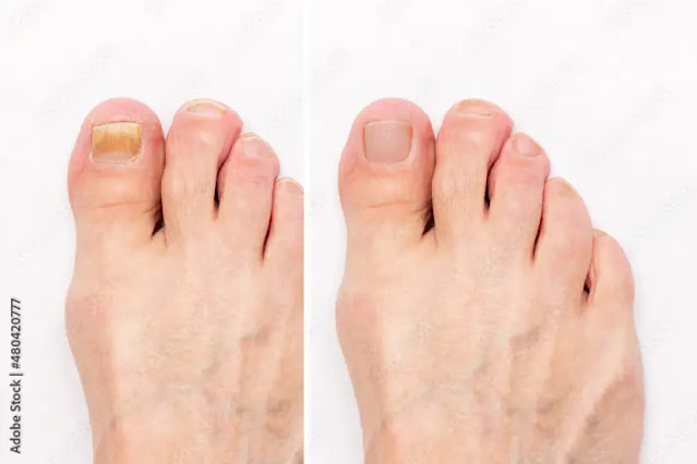 nails vs nail fungus infection