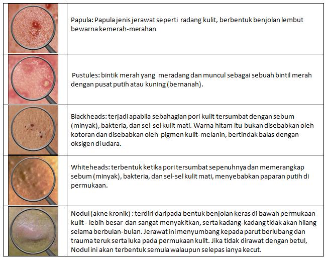 Mengenali Jerawat: Punca & Cara Mengatasi ~ Miracle tabEX