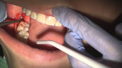 Nhổ 4 răng để niềng răng không đau