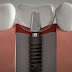Chi phí trồng răng implant phụ thuộc vào yếu tố nào?