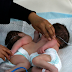 Conjoined Newborn Twins Share One Heart
