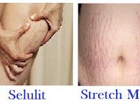 Cara Menghilangkan Stretch Mark Dan Selulit