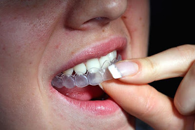 Máng tẩy trắng răng là gì? Ưu điểm sử dụng