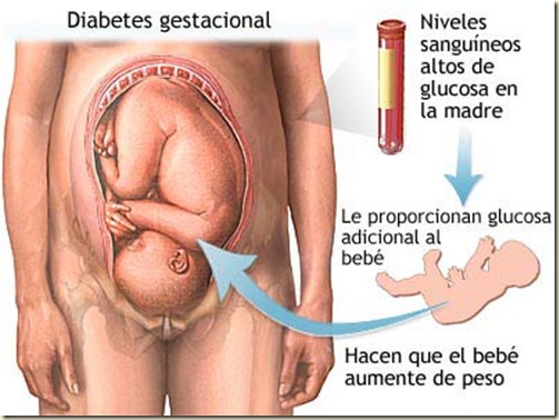 diabetesgestacional