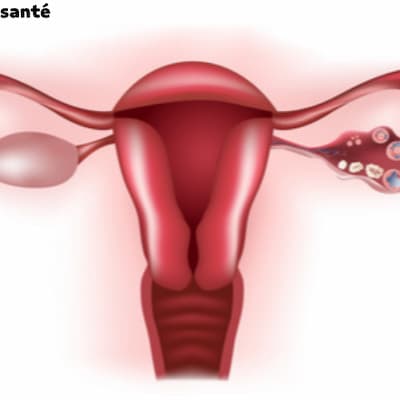 Ovaires polykystiques : causes, symptômes et traitement