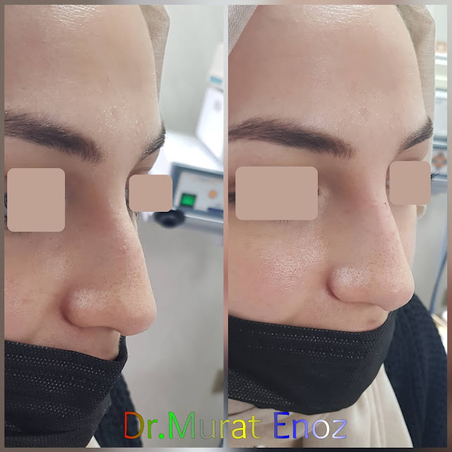 Non-surgical rhinoplasty with filler istanbul