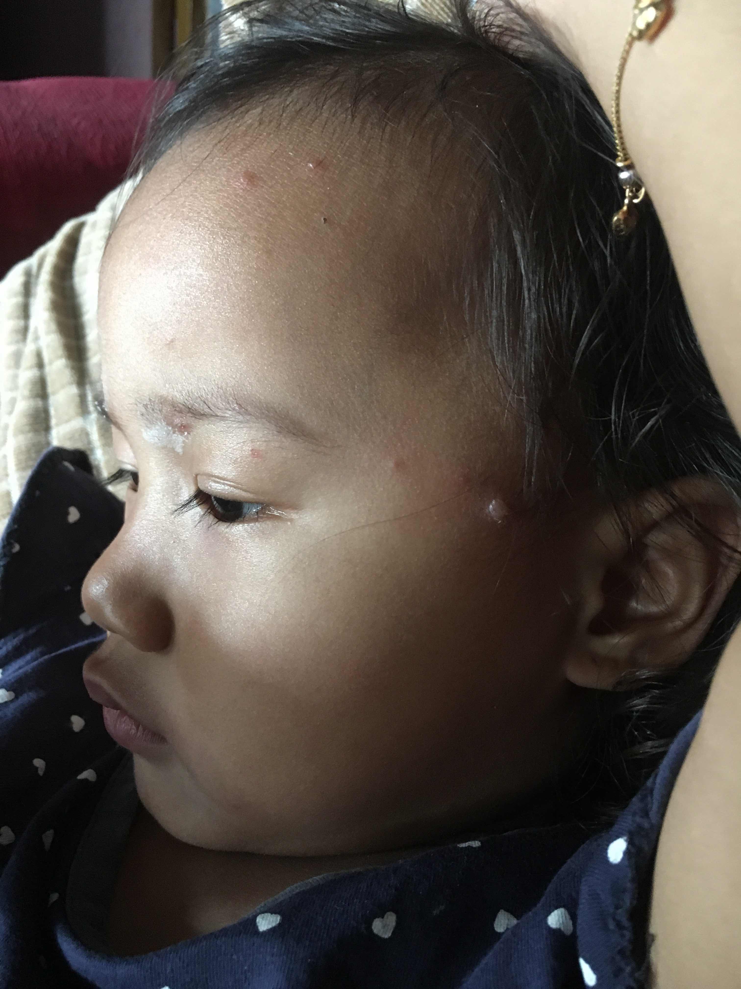 Pengalaman anak kena chicken pox by ibuElly